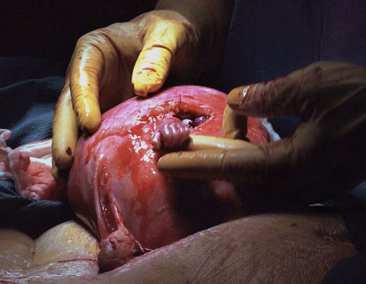 “Fetal Hand Grasp”