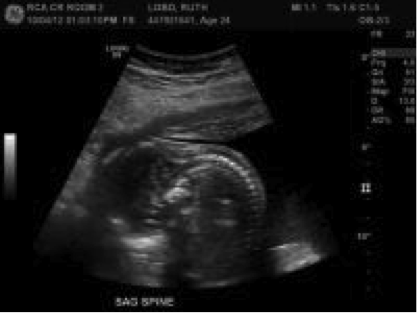 ultrasound of Juth