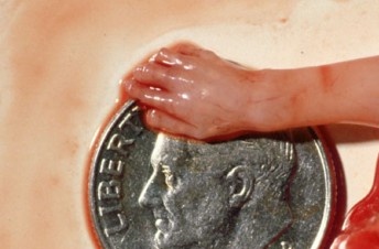 Abortion: The hand of an aborted baby in the first trimester.