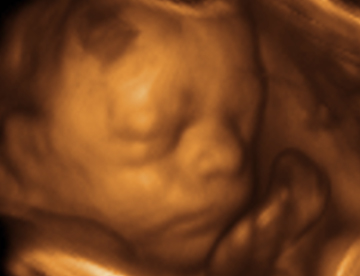 ultrasound, Vermont