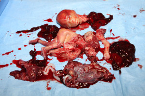 D and E abortion