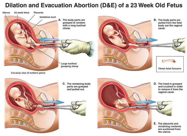 A common second trimester abortion procedure - so common Planned Parenthood lists it as one of two "in-clinic abortion" options
