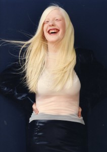 albinism