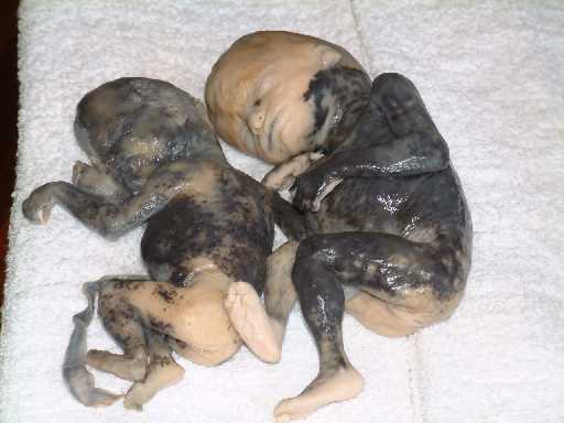 saline aborted babies