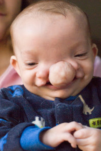 Dominic Pio before surgery.