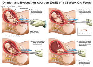 One of the tamer results when doing a google image search of "abortion."