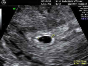 5-week-ultrasound
