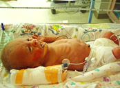 A preemie served by the International Breast Milk Project