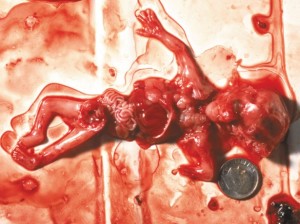 So is this. A 10 week abortion (from abortionno.com)