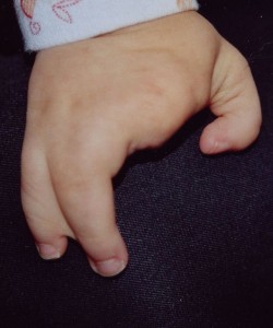 Cleft hand of a one-year-old. This is what the Australian parents thought was worthy of death. (Photo credit: Wikipedia)
