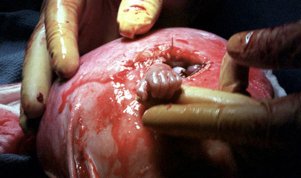 prenatal surgery