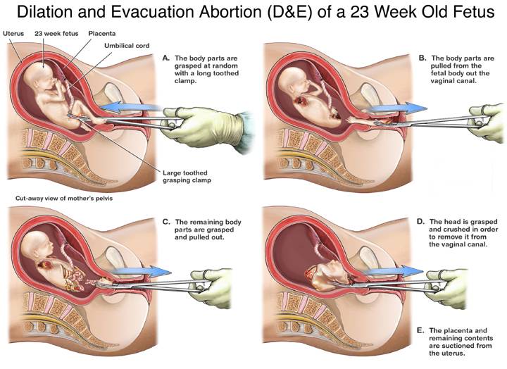 DEabortiongraphic