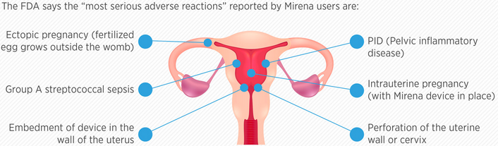 35 Mirena Iud Diagram