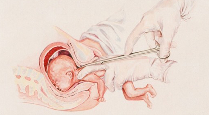 partial-birth abortion