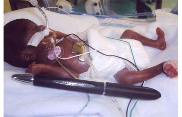 Amillia Taylor, a premature baby who was born at only 21 weeks gestation -- and survived.