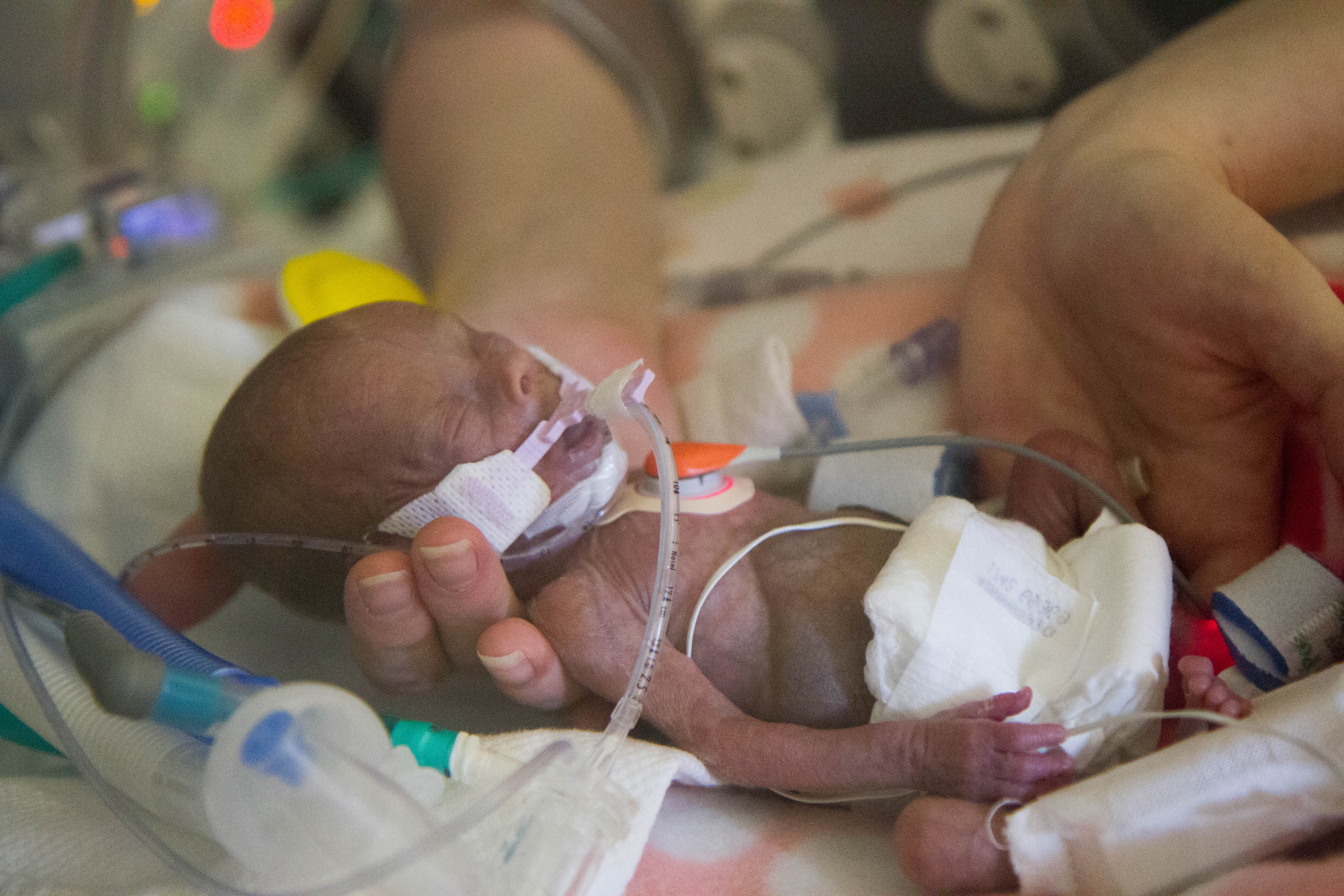 4 Babies Who Prove Babies Born Before 24 Weeks Can Survive