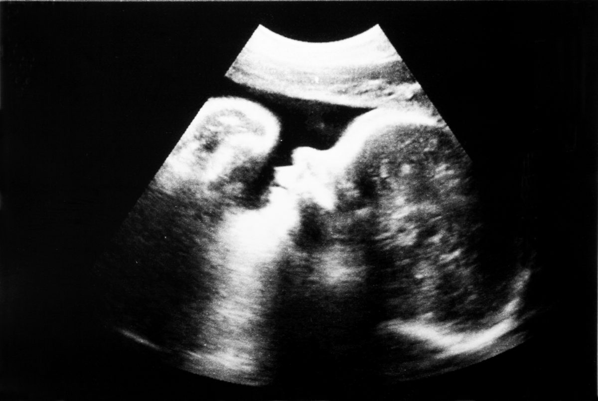 ultrasound, ultrasounds