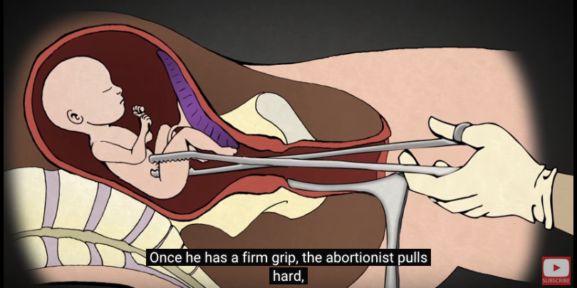 dismemberment abortions D&E abortion removes baby's limb, Go to www.AbortionProcedures.com for facts on abortion