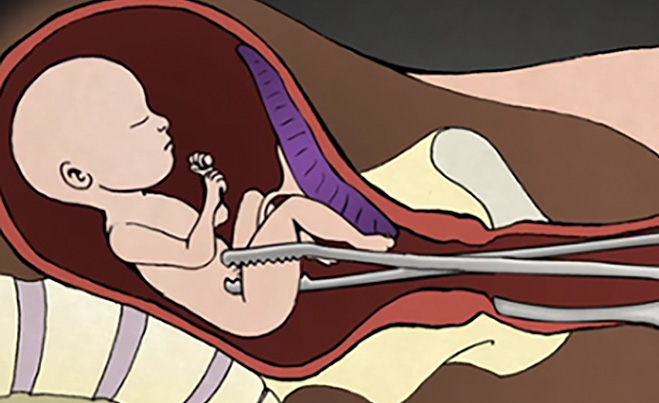Második trimeszteri sebészeti abortusz ismertetése