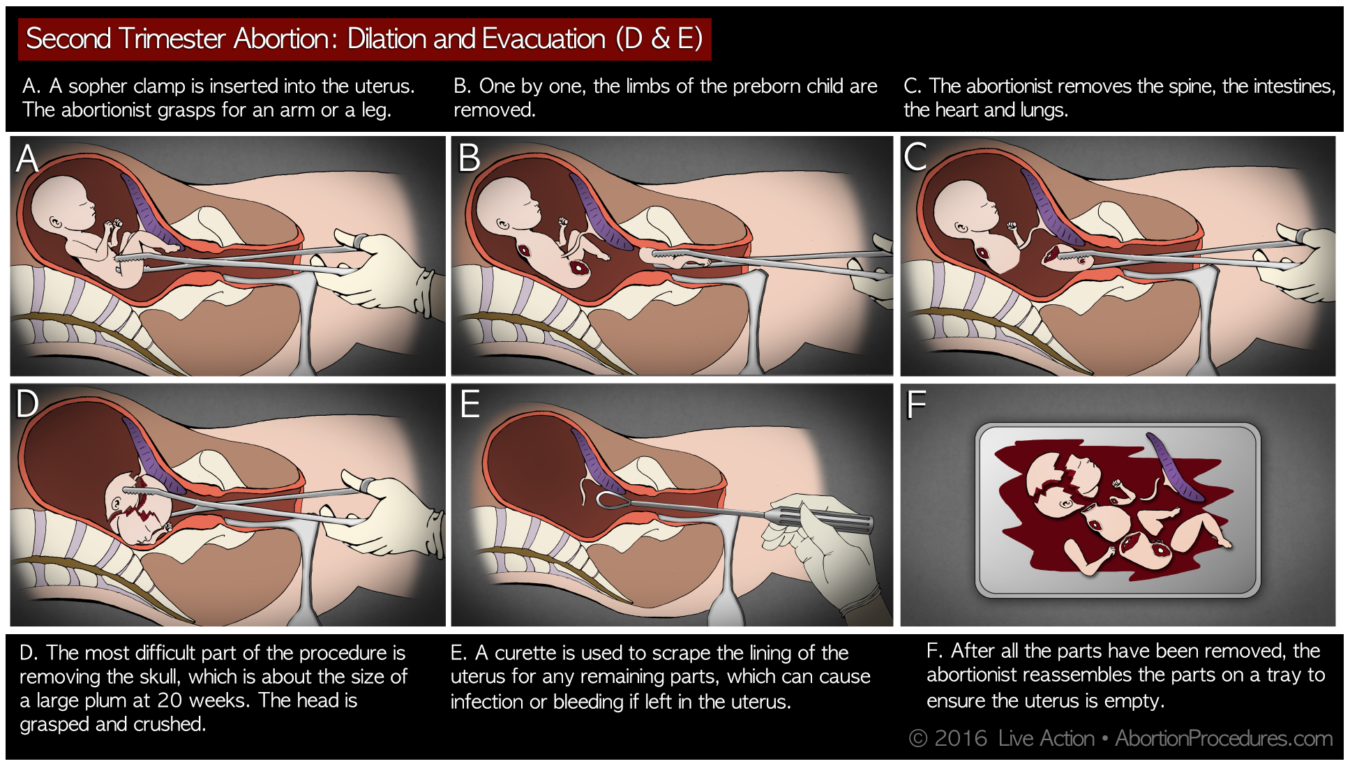 D&E abortion: the facts in pictures