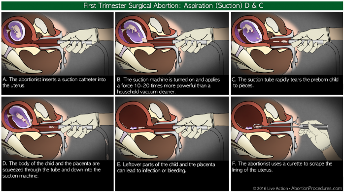 Suction D & C 6 panel