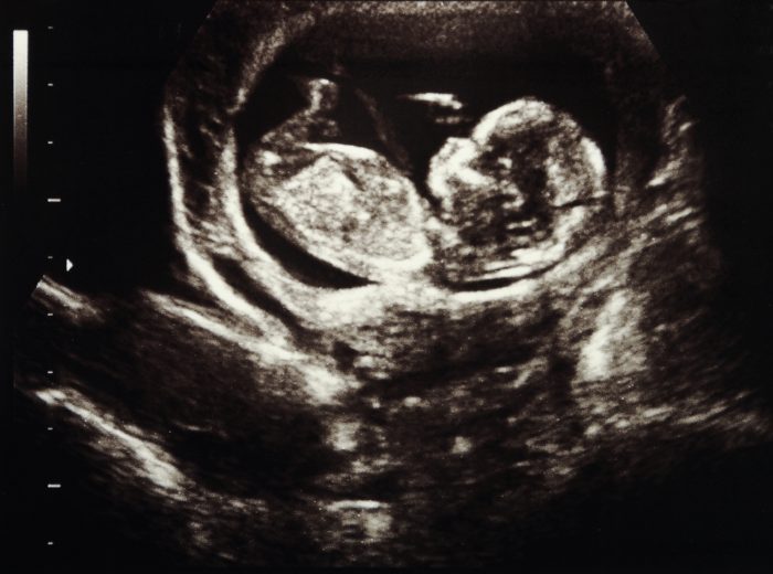 Pregnancy centers offer free ultrasounds