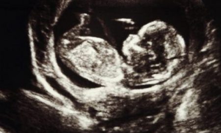 ultrasound, pregnant, Ireland, abortion, rape, abortions, pregnancy resource center, ultrasound