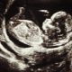 ultrasound, pregnant, Ireland, abortion, rape, abortions, pregnancy resource center, ultrasound