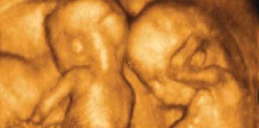 twins, abortion pill reversal, selective reduction