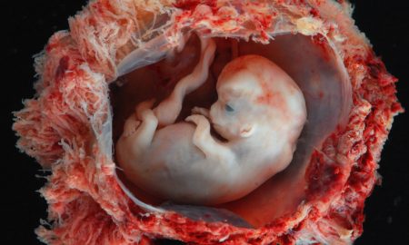 8 weeks gestation (Photo credit: Lunar Caustic), abortion