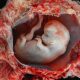 8 weeks gestation (Photo credit: Lunar Caustic), abortion