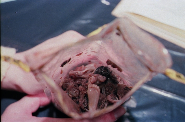 Foot of a 21-week-old aborted baby, killed by D&E abortion procedure.