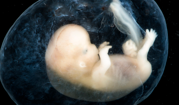 ectopic pregnancy, eight weeks, miscarriage, baby, fetus, embryo, fetal
