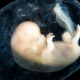 ectopic pregnancy, eight weeks, miscarriage, baby, fetus, embryo, fetal