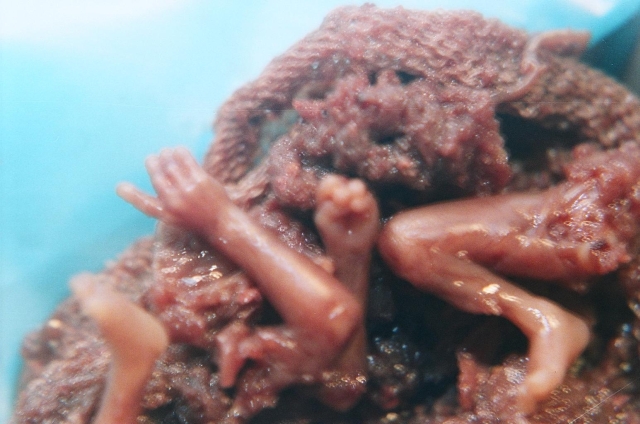 Remains of a baby aborted by D&amp;E. From Citizens for a Pro-Life Society