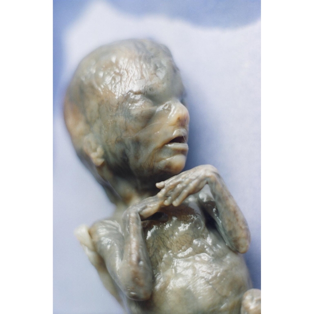 Baby aborted by saline method. From Citizens for a Pro-Life Society.