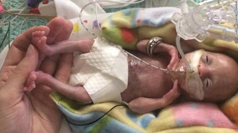Miracle: Born at 21 weeks, 'most premature' baby is thriving
