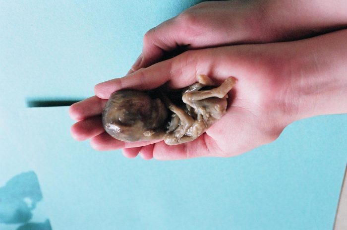 This 21-week old preborn child was killed through a prostaglandin abortion.