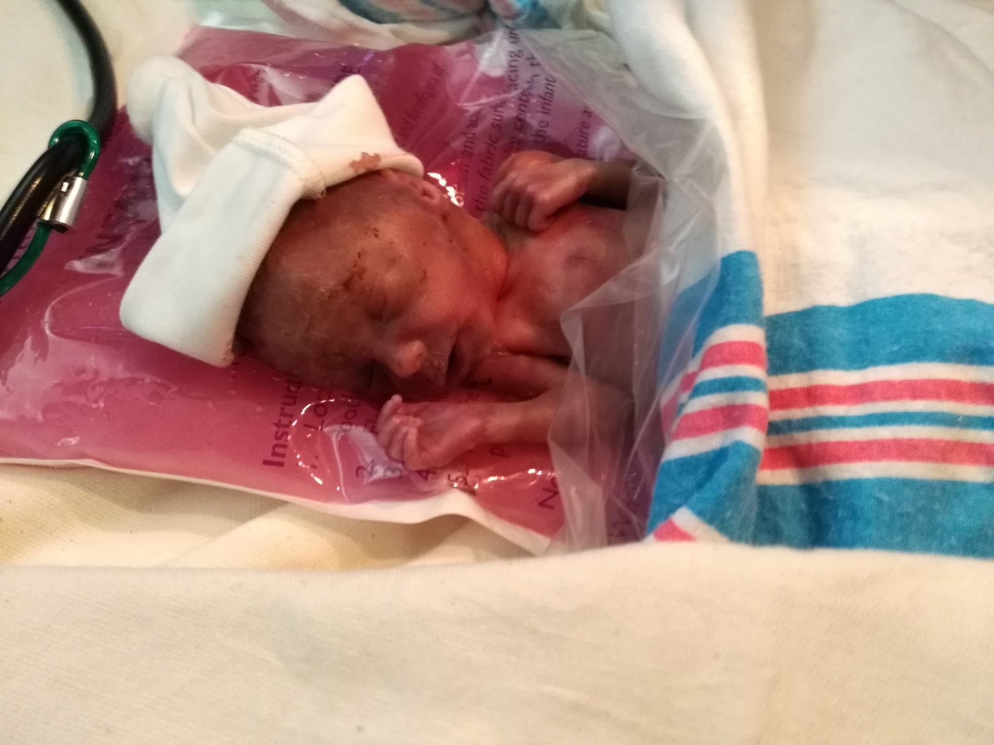 Preemie of the Week: Doctors left Benson to die at birth, but his parents fought for him