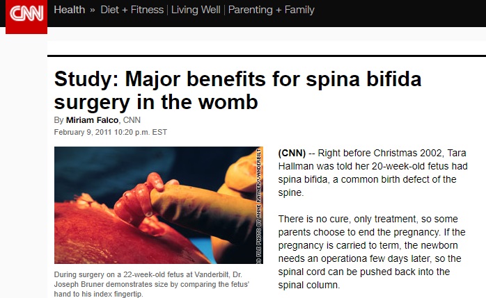 Fetal Surgery CNN Report