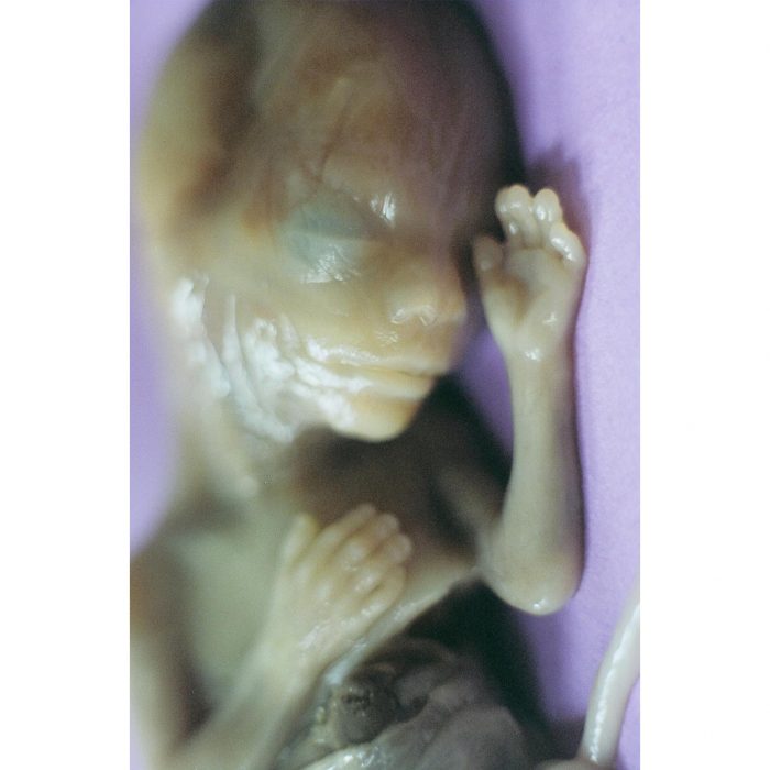 This preborn child was aborted at 21 weeks gestation through a Prostaglandin abortion.