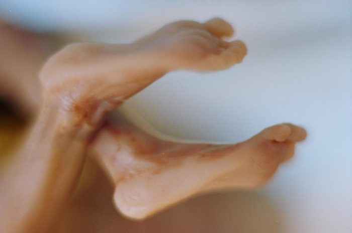 The tiny feet of a 21-week old preborn child killed by a prostaglandin abortion. 