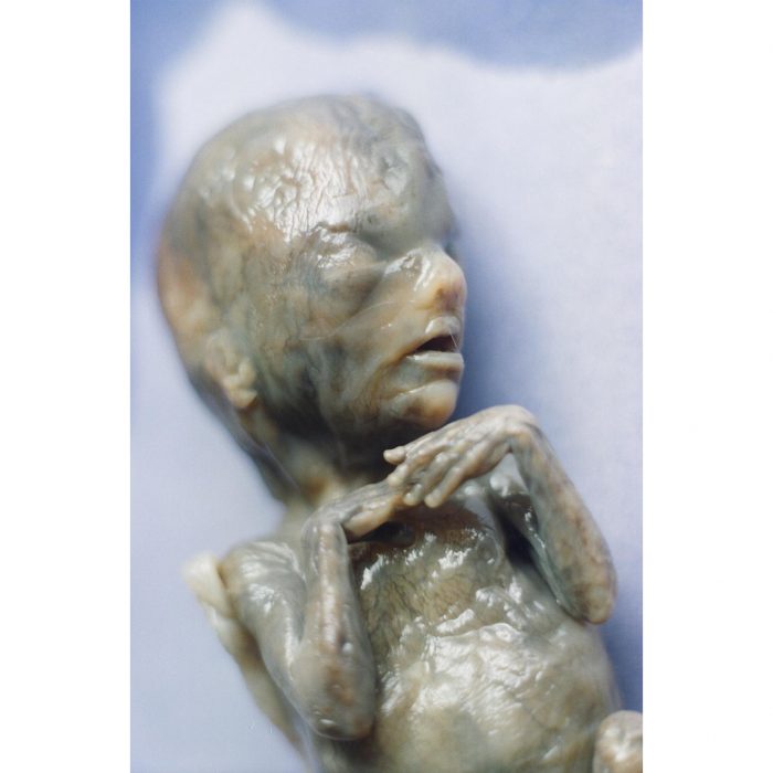 This child was aborted at 18 weeks gestation using the saline abortion method - note the burned skin.
