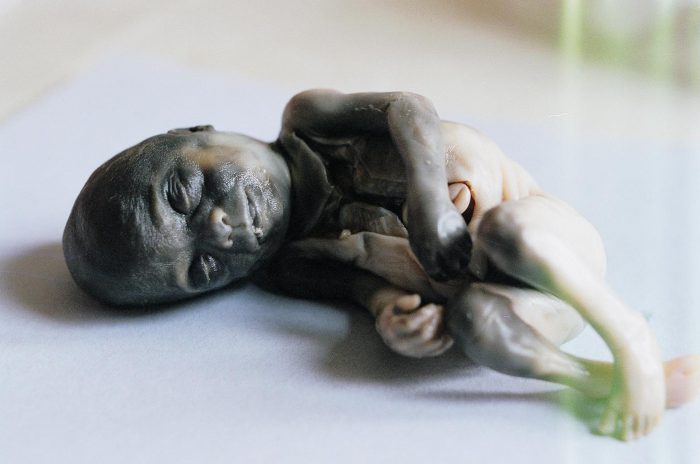 A late-term baby who was killed by abortion.