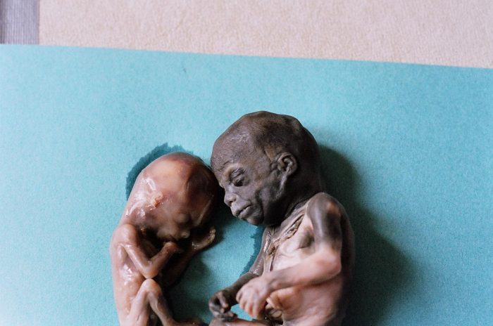 Two children who died, one after the other, from abortion.