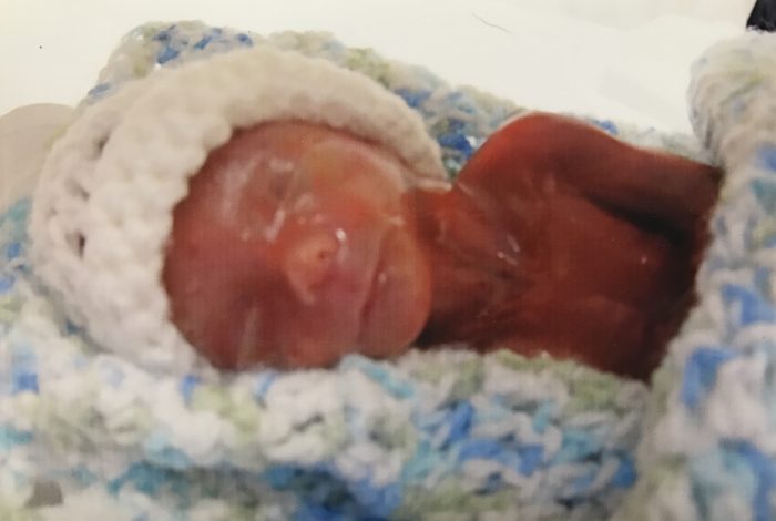 Premature baby Luke was born at 18 and a half weeks gestation. Photo courtesy of Meghann Jacobs.