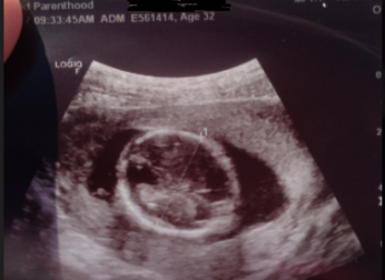 abortion, Planned Parenthood