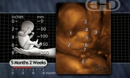 late-term abortion, ultrasound