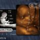 late-term abortion, ultrasound