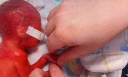 premature baby